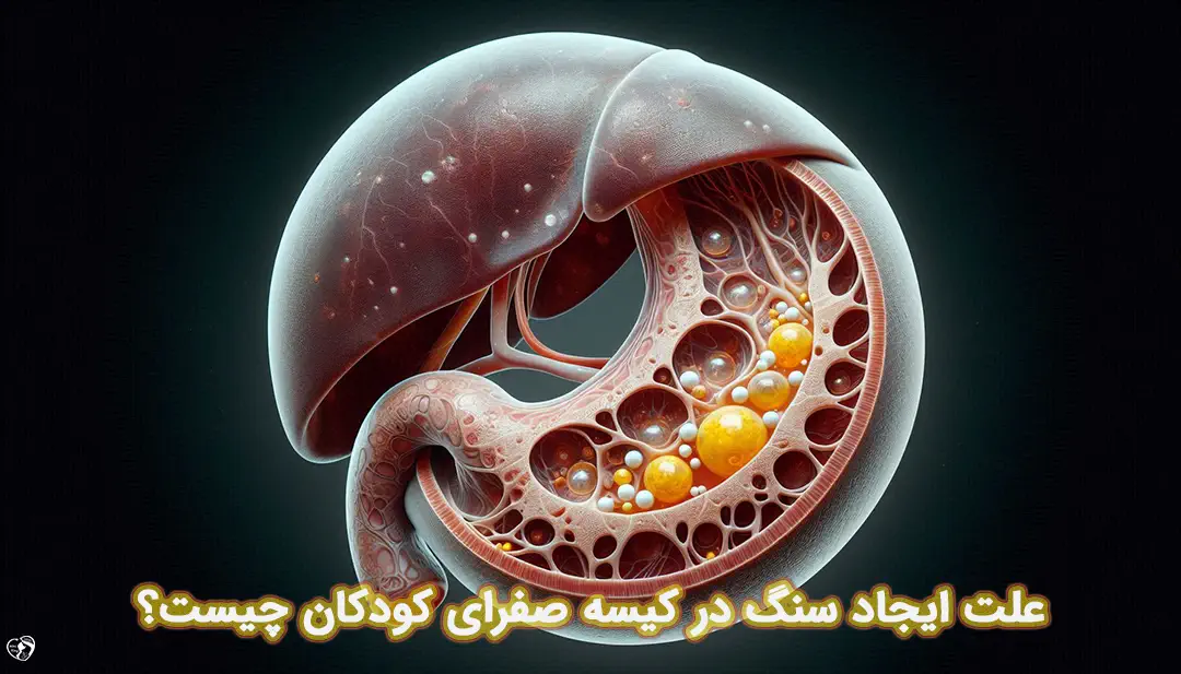 سنگ کیسه صفرا در کودکان سنگ کیسه صفرا در کودکان