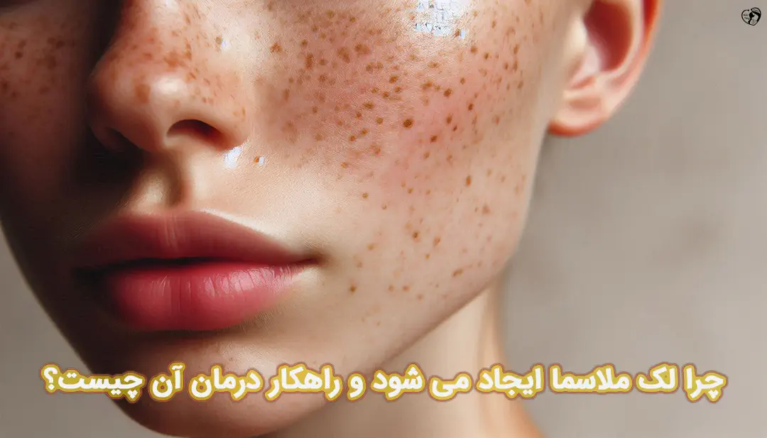لک ملاسما