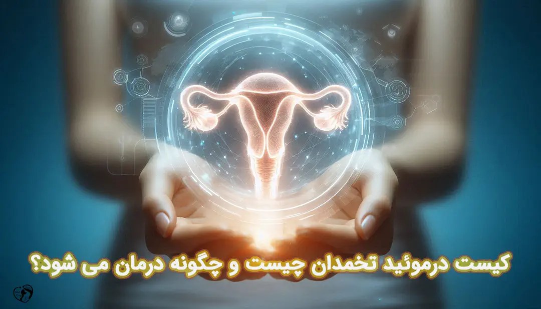 کیست درموئید تخمدان