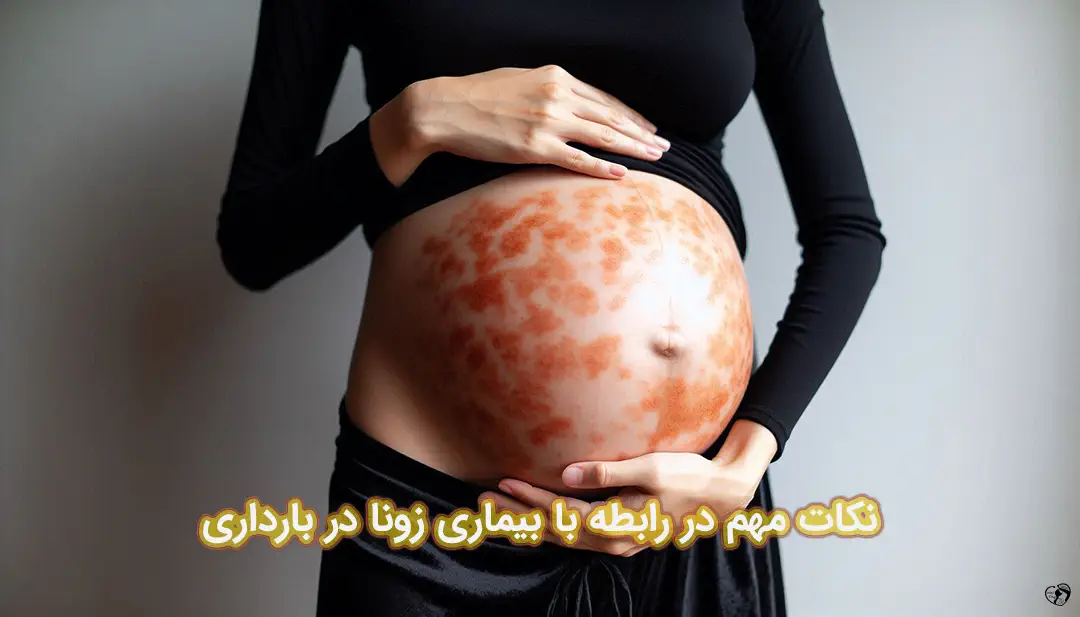 زونا در بارداری