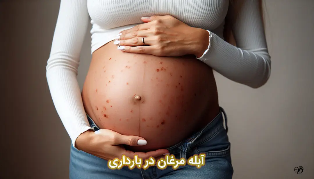 آبله مرغان در بارداری آبله مرغان در بارداری