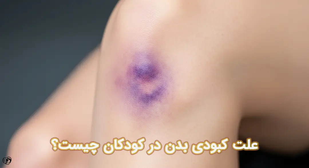 کبودی بدن در کودکان کبودی بدن در کودکان