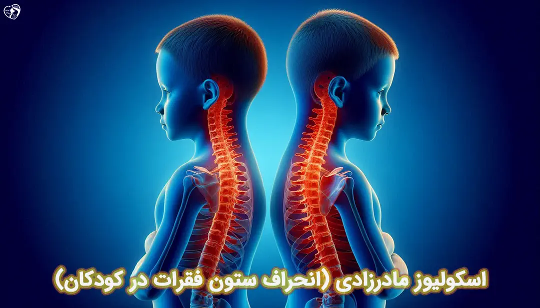 اسکولیوز مادرزادی اسکولیوز مادرزادی