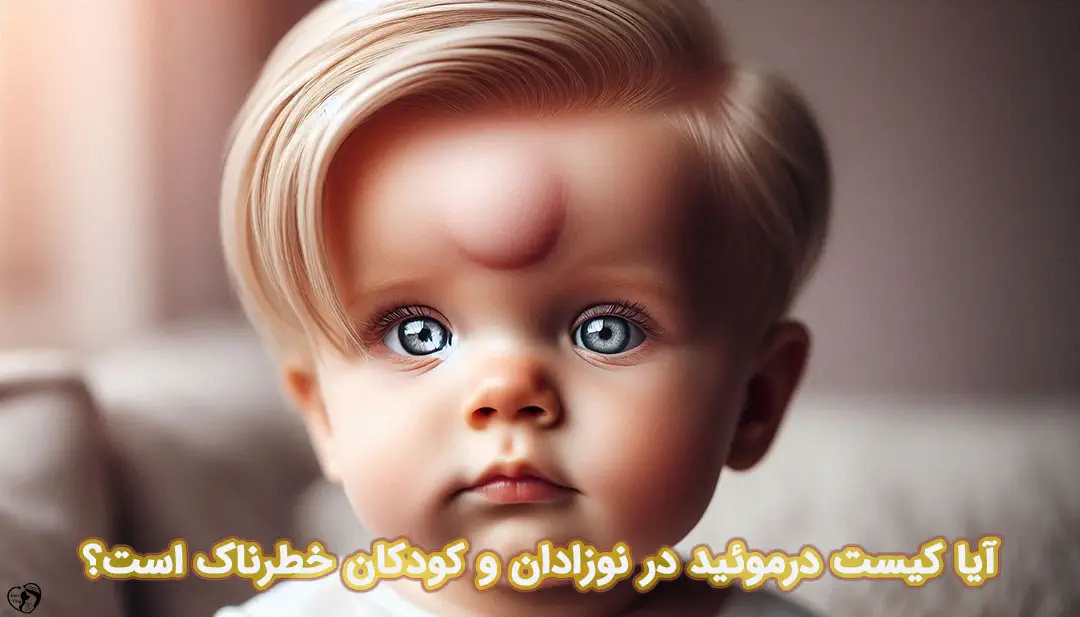 کیست درموئید در نوزادان کیست درموئید در نوزادان