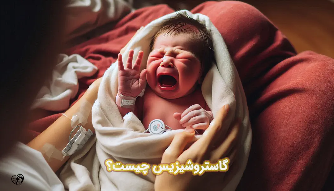 گاستروشیزیس در نوزادان گاستروشیزیس در نوزادان