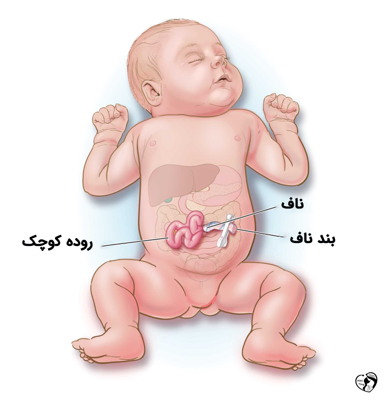 گاستروشیزیس در نوزادان
