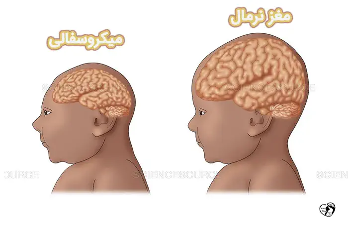 میکروسفالی