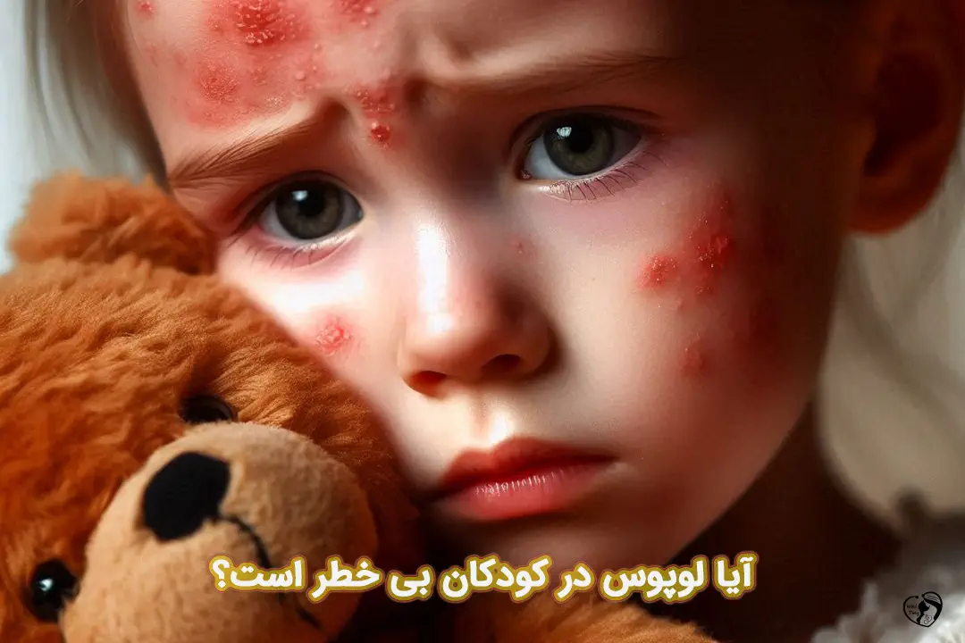 لوپوس در کودکان لوپوس در کودکان