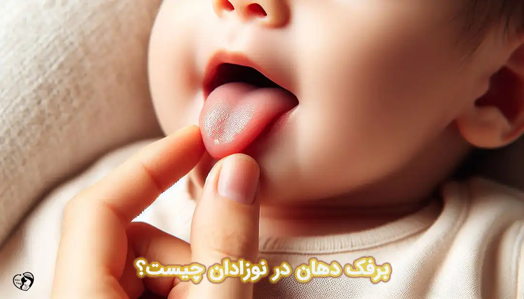 Oral Thrush_compressed برفک دهان در نوزادان