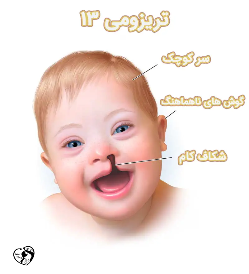 تریزومی 13