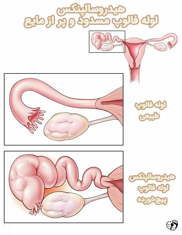 هیدروسالپنکس