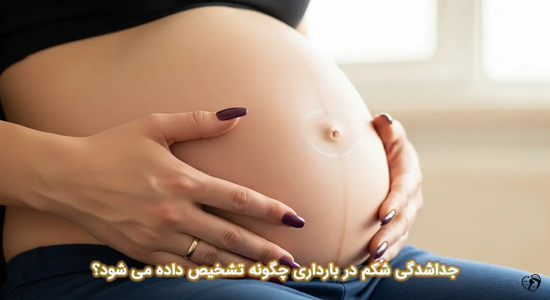 جداشدگی شکم در بارداری