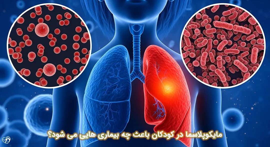 مایکوپلاسما در کودکان مایکوپلاسما در کودکان