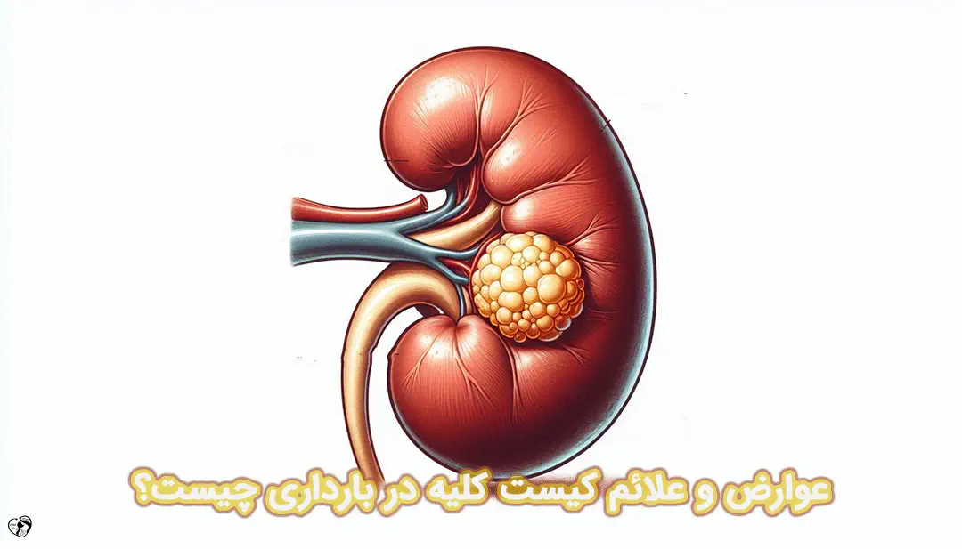 کیست کلیه در بارداری