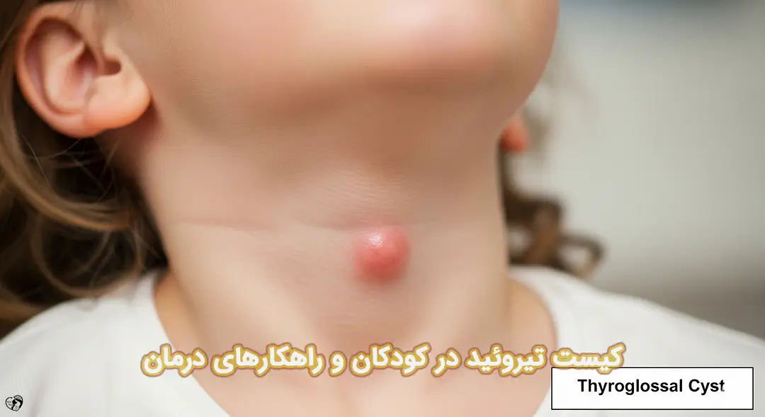 کیست تیروئید در کودکان کیست تیروئید در کودکان