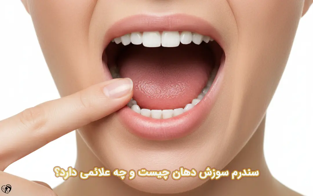 سندرم سوزش دهان سندرم سوزش دهان