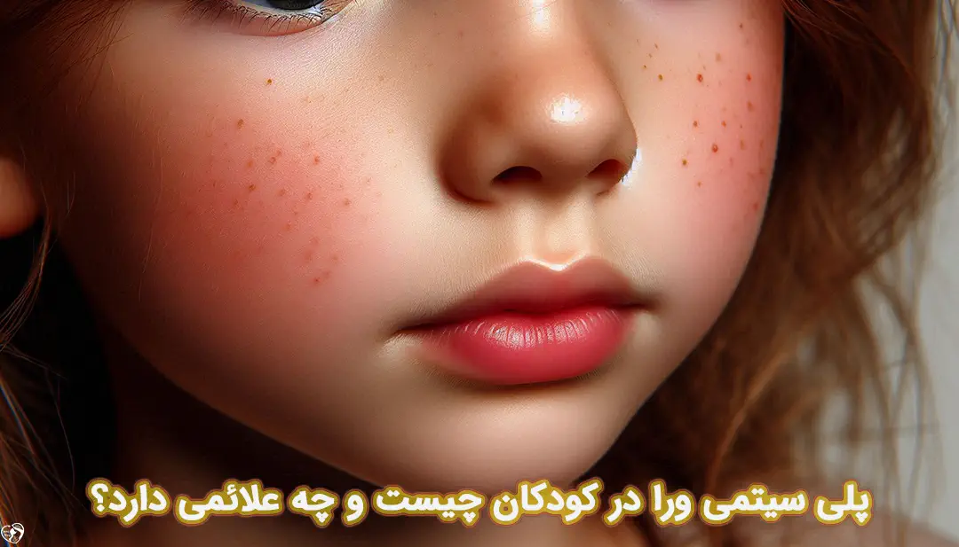 پلی سیتمی ورا در کودکان پلی سیتمی ورا در کودکان