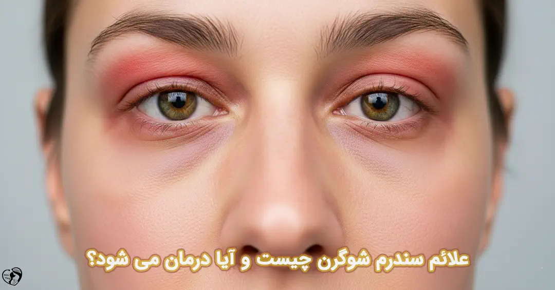 سندرم شوگرن سندرم شوگرن