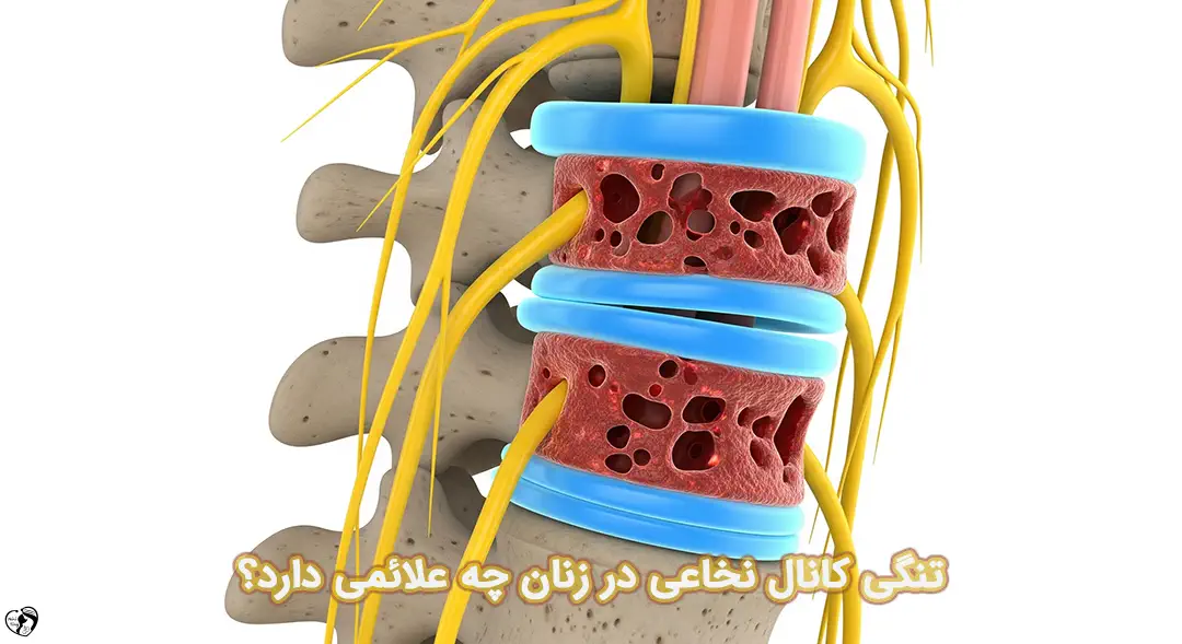 تنگی کانال نخاعی در زنان