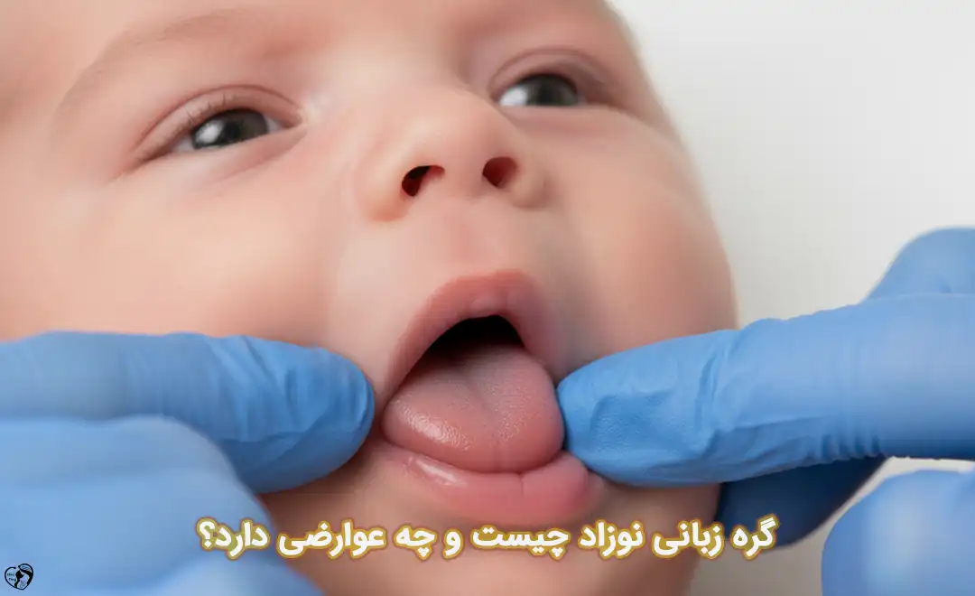 گره زبانی نوزاد