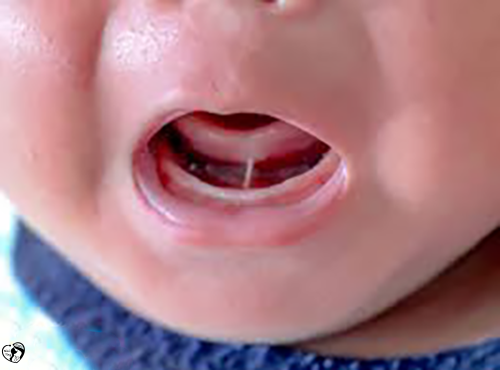 گره زبانی نوزاد