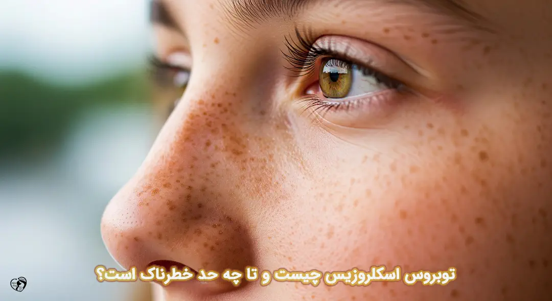 توبروس اسکلروزیس توبروس اسکلروزیس