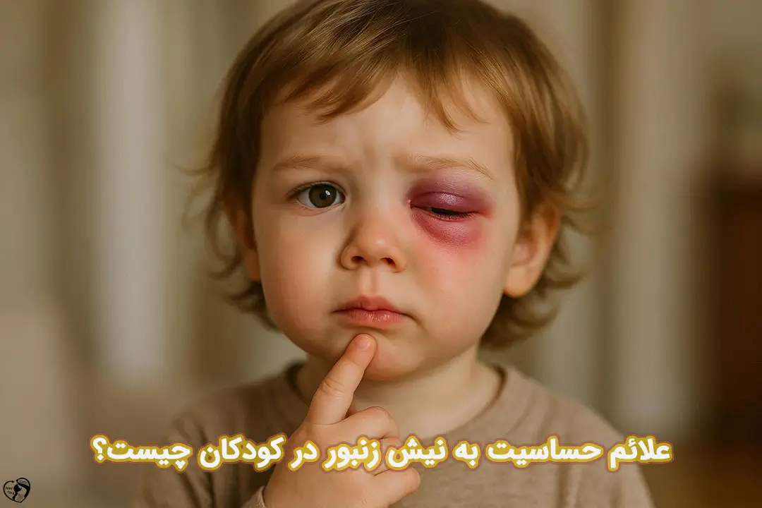 نیش زنبور در کودکان نیش زنبور در کودکان