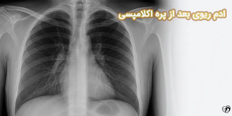 Defining Characteristics of Pulmonary Edema in Severe Preeclampsia ادم ریوی بعد از پره اکلامپسی