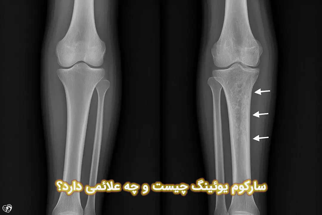 سارکوم یوئینگ سارکوم یوئینگ