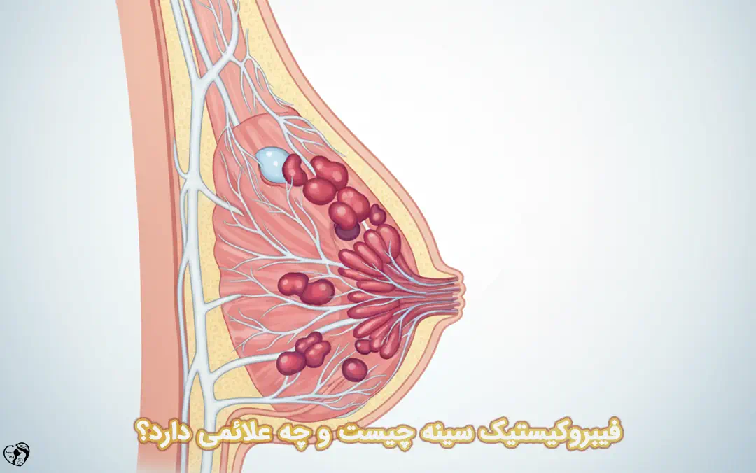 فیبروکیستیک سینه