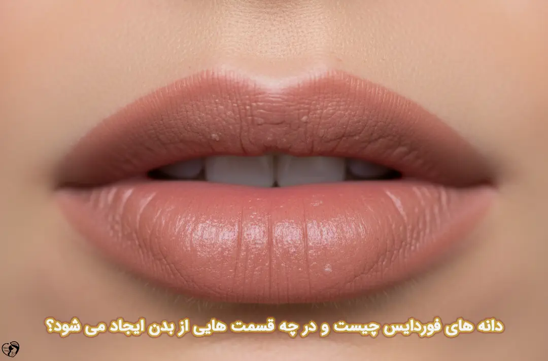 دانه های فوردایس