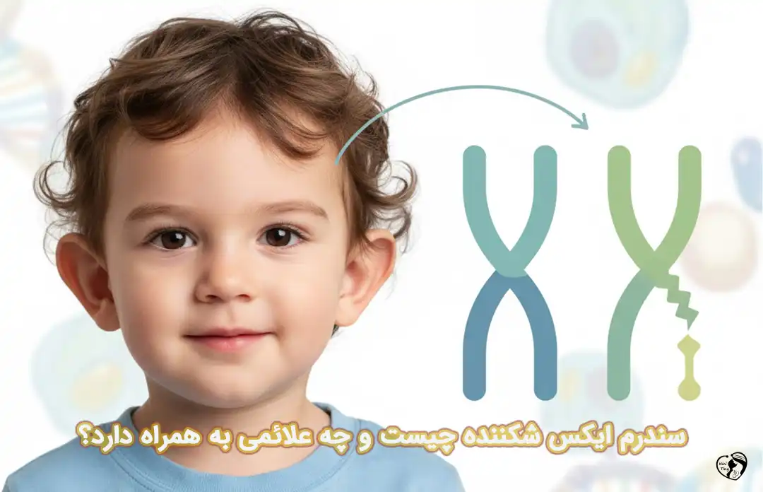 سندرم ایکس شکننده سندرم ایکس شکننده