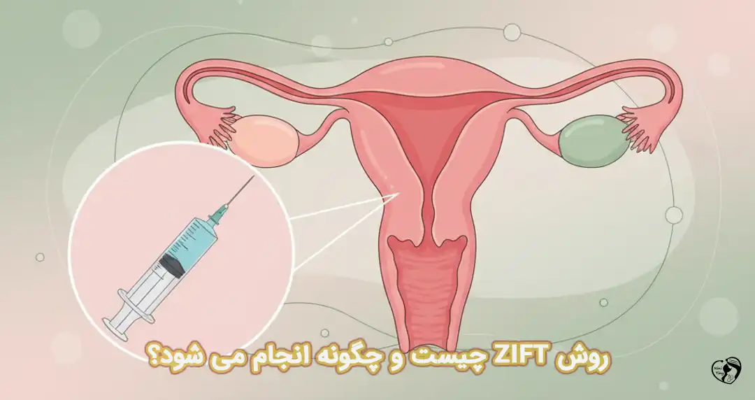 درمان ناباروری با روش ZIFT درمان ناباروری با روش ZIFT
