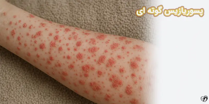 Guttate Psoriasis پسوریازیس گوته ای