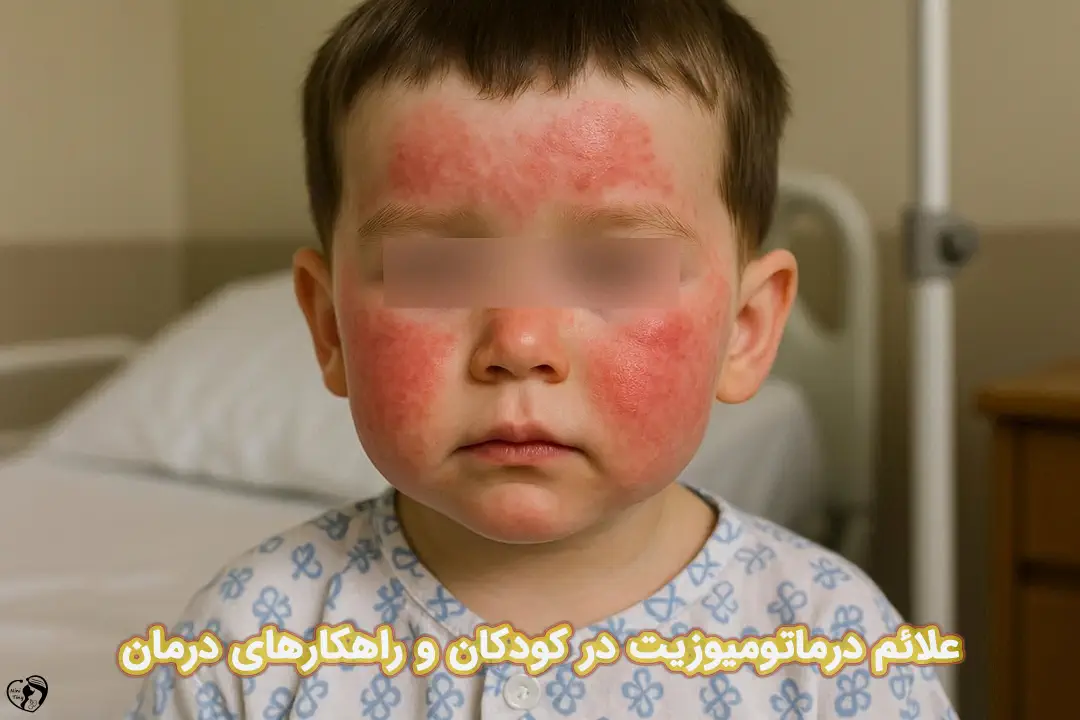 درماتومیوزیت در کودکان درماتومیوزیت در کودکان