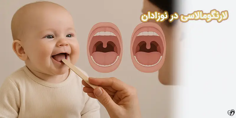 Laryngomalacia لارنگومالاسی در نوزادان