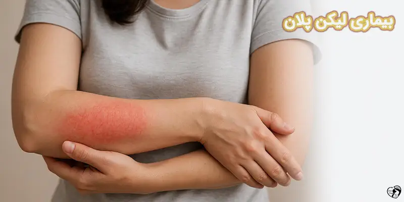Lichen Planus بیماری لیکن پلان