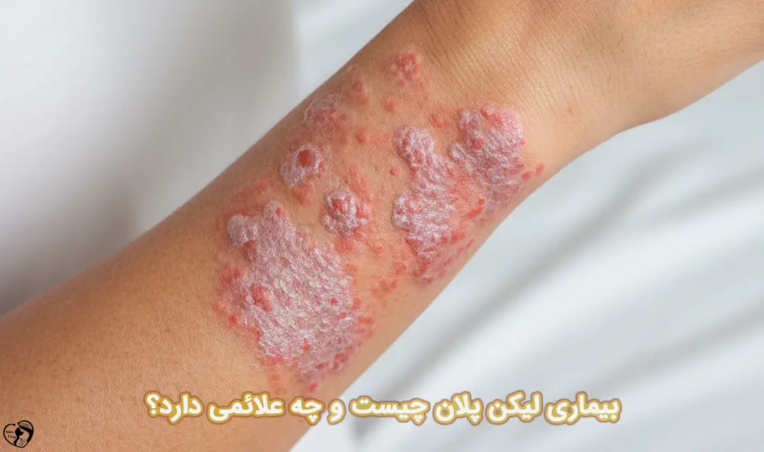 بیماری لیکن پلان بیماری لیکن پلان