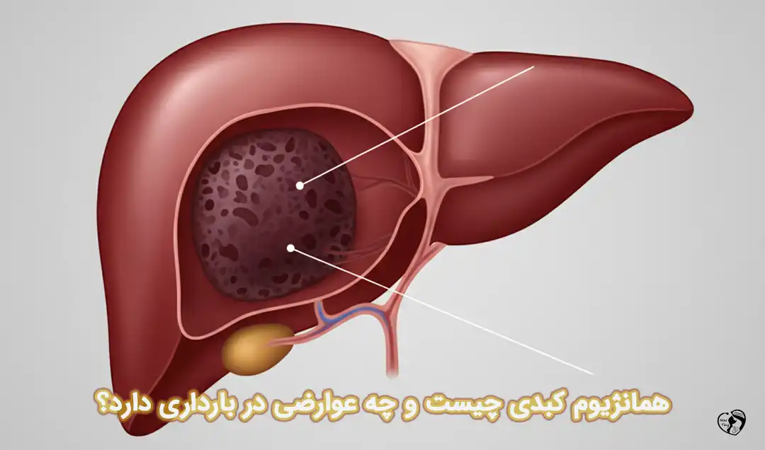 همانژیوم کبدی در بارداری همانژیوم کبدی در بارداری