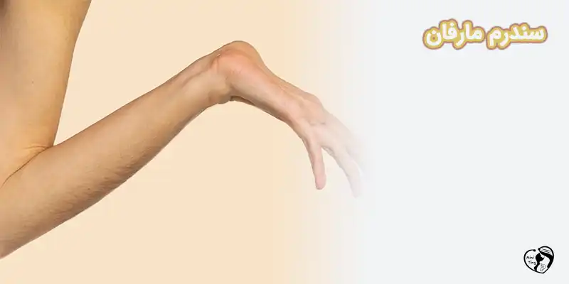 سندرم مارفان
