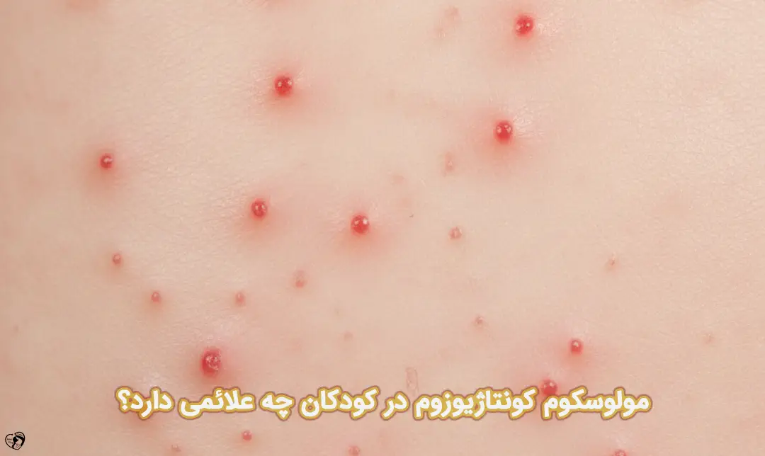 مولوسکوم کونتاژیوزوم مولوسکوم کونتاژیوزوم