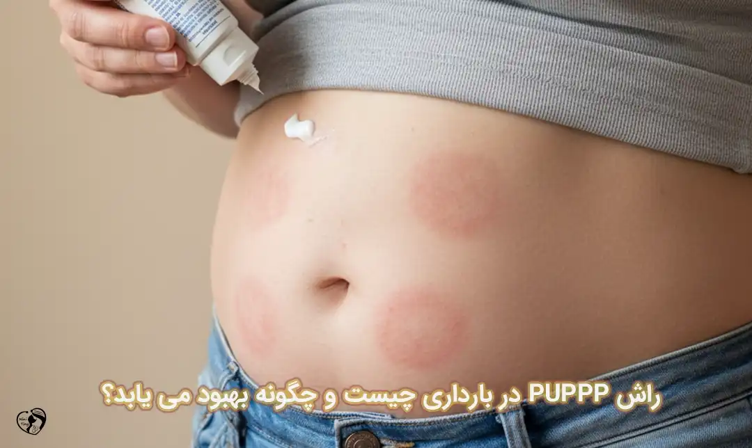 راش PUPPP در بارداری راش PUPPP در بارداری