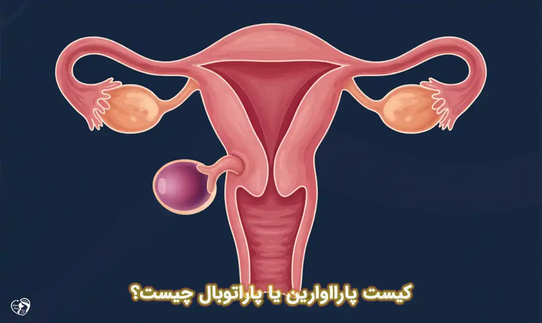 کیست پارااوارین کیست پارااوارین