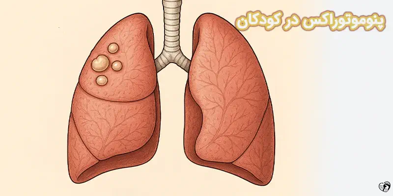 Pneumothorax in Children پنوموتوراکس در کودکان