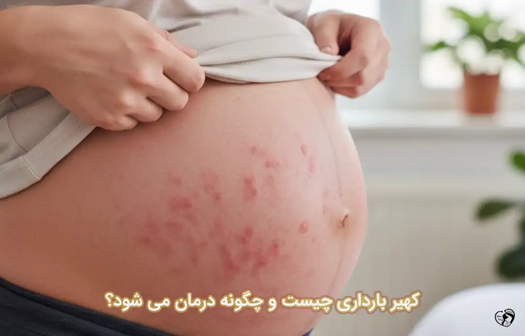 کهیر بارداری کهیر بارداری