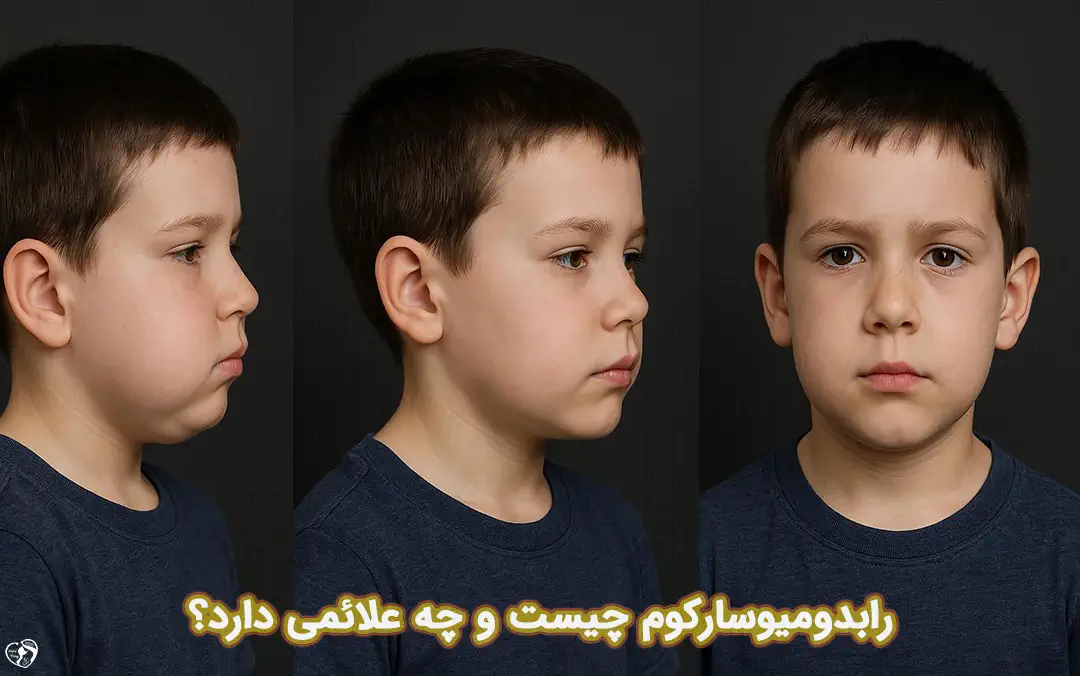رابدومیوسارکوم رابدومیوسارکوم