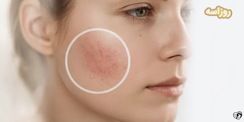 Rosacea روزاسه