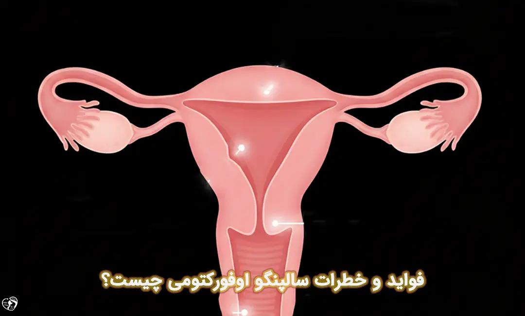 سالپنگو اوفورکتومی