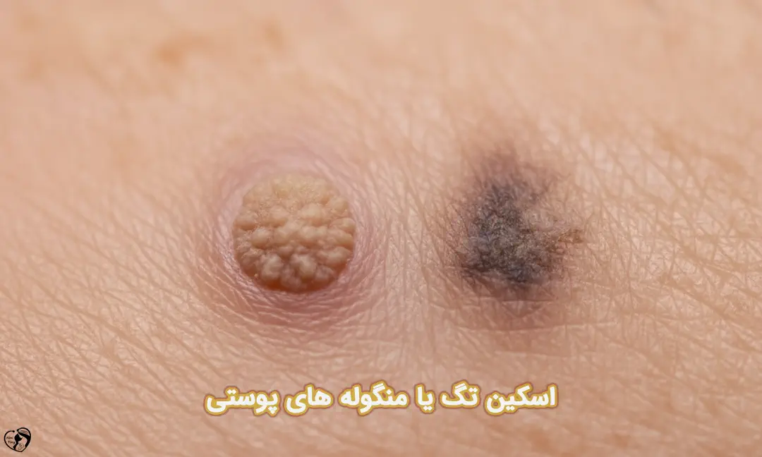 اسکین تگ اسکین تگ