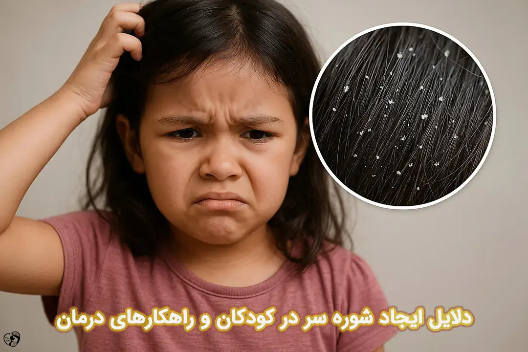 شوره سر در کودکان شوره سر در کودکان